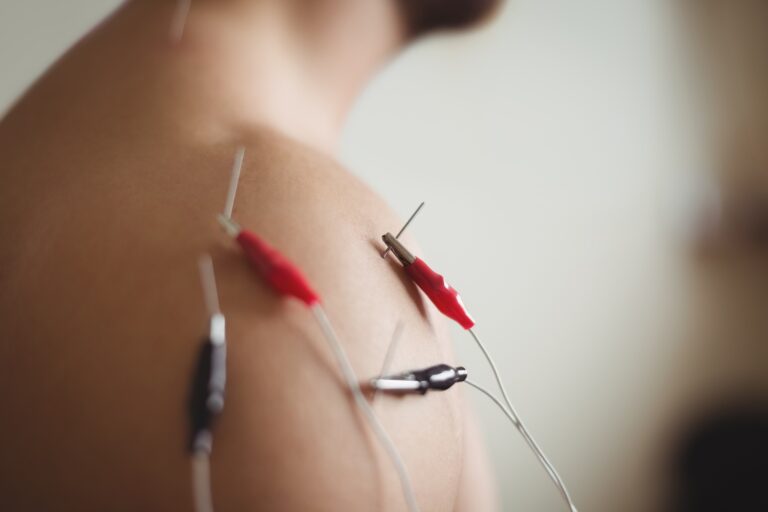 Elektroigłoterapia